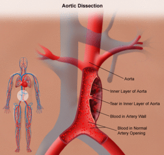 aneurysma břišní aorty