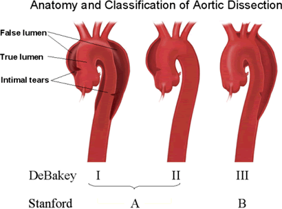 výduť hrudní aorty