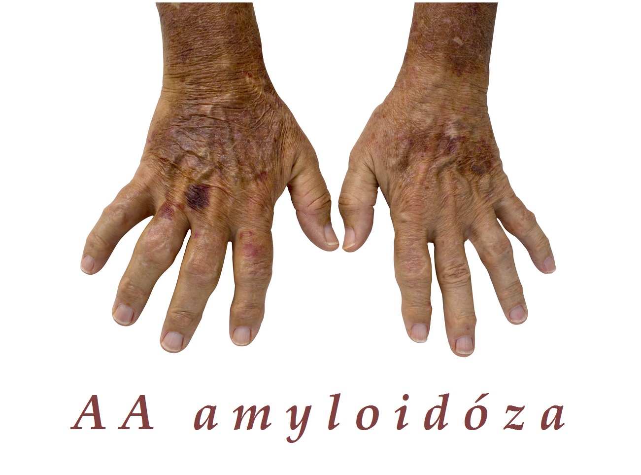 aa amyloidoza sekundarni zanetliva amyloidoza priznaky projevy symptomy