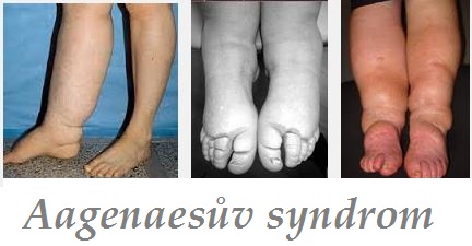 aagenaesuv-syndrom-priznaky-projevy-symptomy