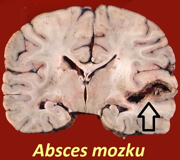 absces-mozku-mozkovy-absces-priznaky-projevy-symptomy