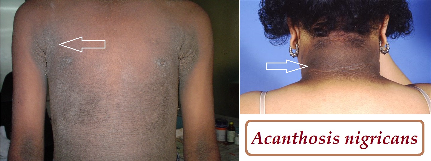 acanthosis nigricans priznaky projevy symptomy