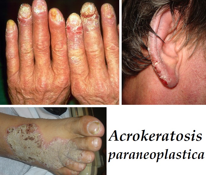 acrokeratosis-paraneoplastica-priznaky-projevy-symptomy