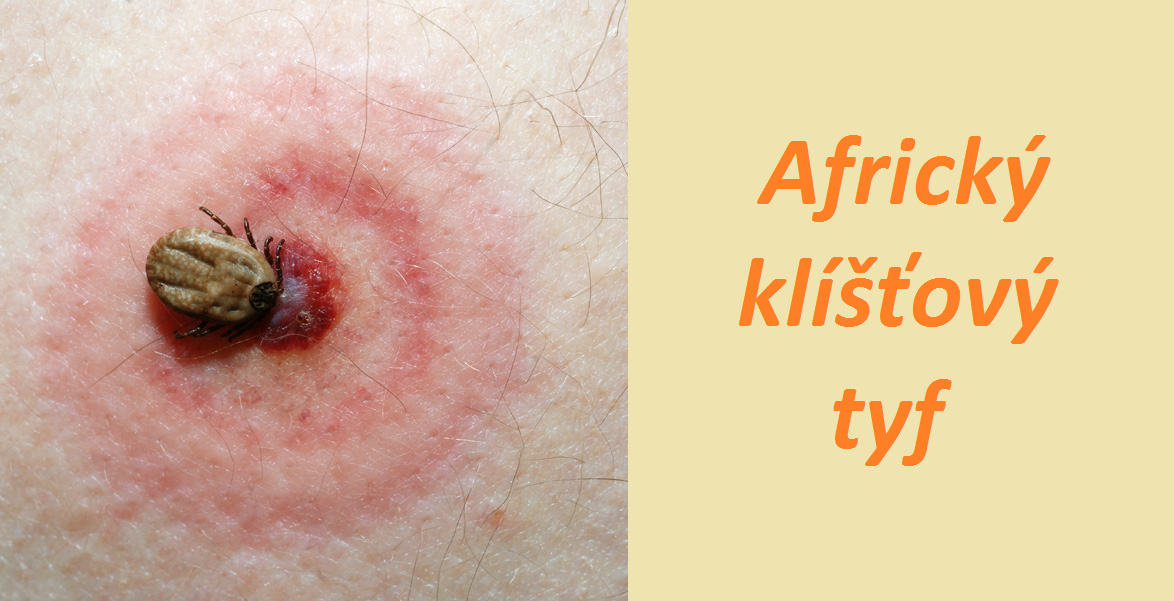 Africký klíšťový tyf tyfus příznaky projevy symptomy léčba obrázek fotografie