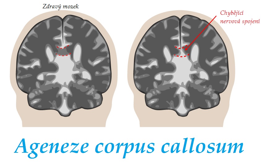 ageneze corpus callosum priznaky projevy symptomy