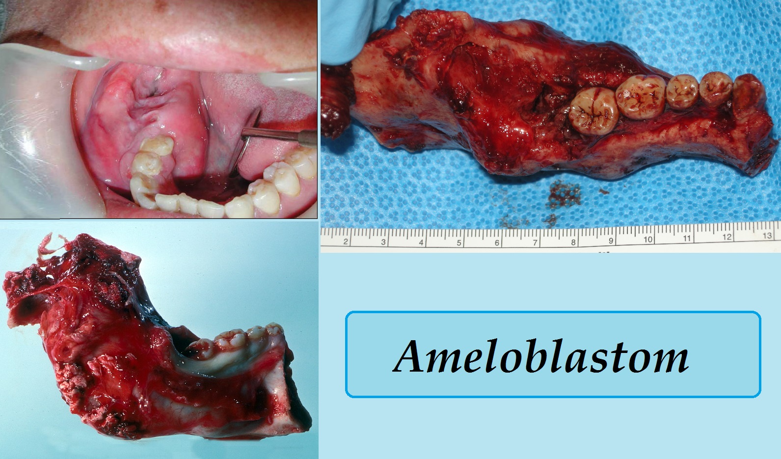 ameloblastom-priznaky-projevy-symptomy
