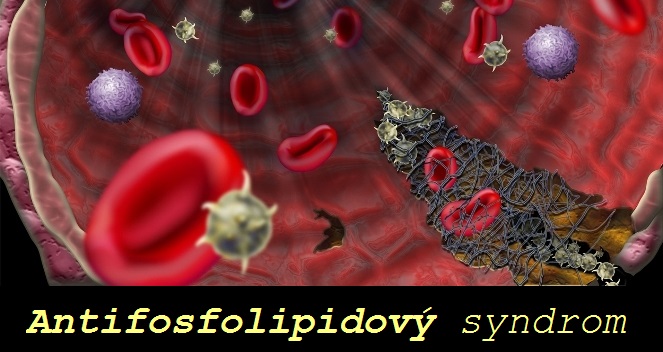 antifosfolipidovy-syndrom-priznaky-projevy-symptomy