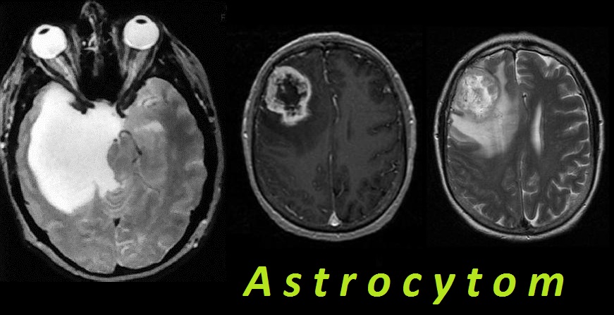 astrocytom-mozku-priznaky-projevy-symptomy
