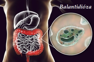 Balantidióza příznaky projevy symptomy příčina léčba