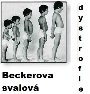 beckerova-svalova-dystrofie-priznaky-projevy-symptomy