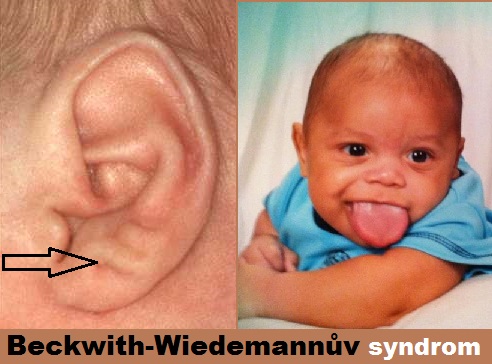 beckwith-wiedemannuv-syndrom-bws-emg-syndrom-priznaky-projevy-symptomy