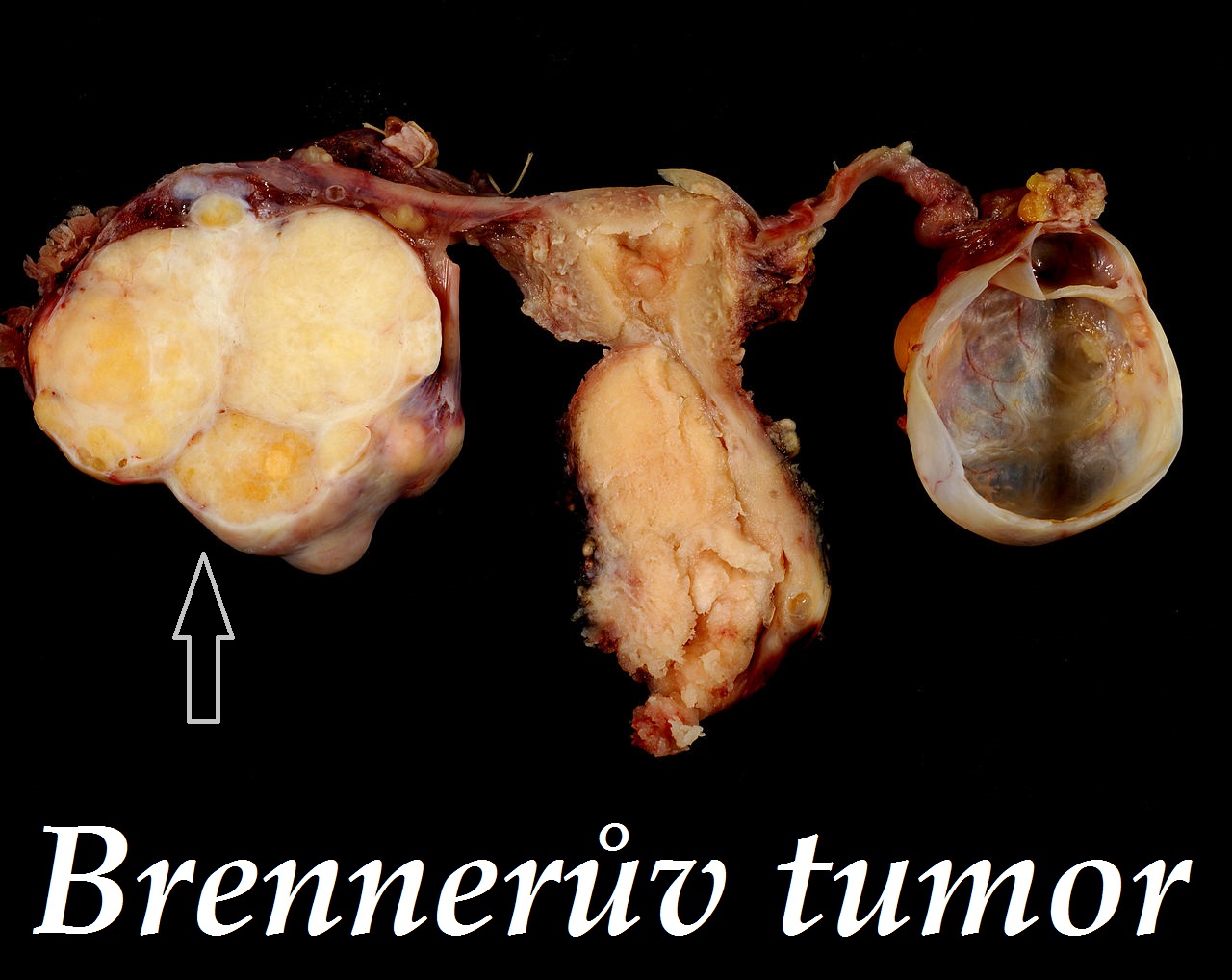 brenneruv-tumor-priznaky-projevy-symptomy