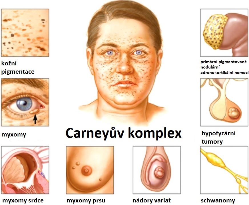 Carneyův syndrom komplex příznaky projevy příčina léčba fotografie obrázek symptomy