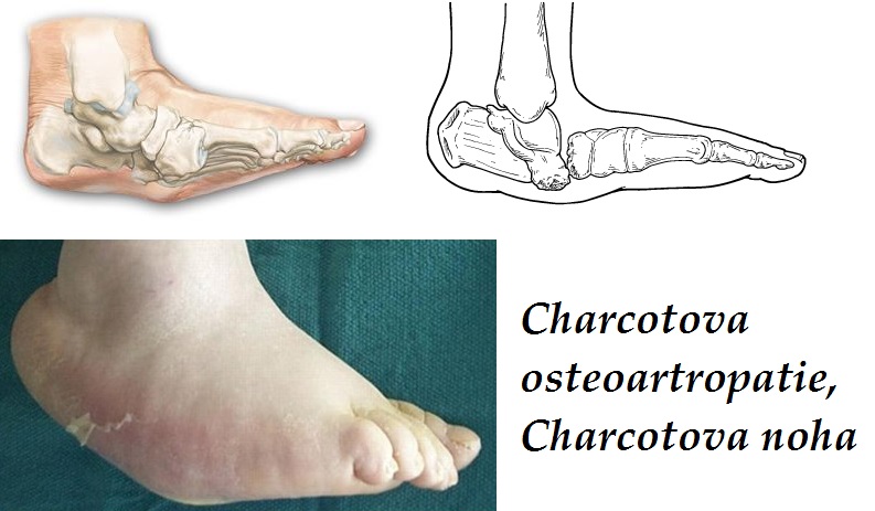 charcotova osteoartropatie charcotova noha priznaky projevy symptomy