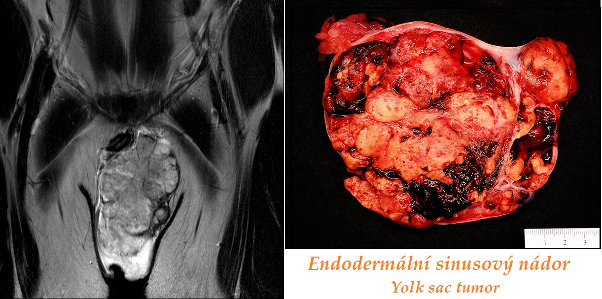 endodermalni-sinusovy-nador-yolk-sac-tumor-priznaky-projevy-symptomy