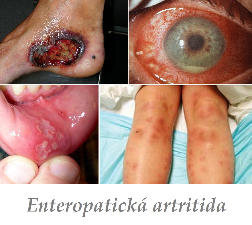 enteropaticka artritida enteropaticka artropatie priznaky projevy symptomy