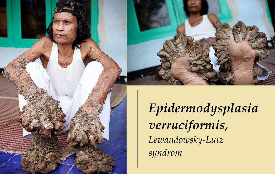 epidermodysplasia verruciformis lewandowsky lutz syndrom priznaky projevy symptomy