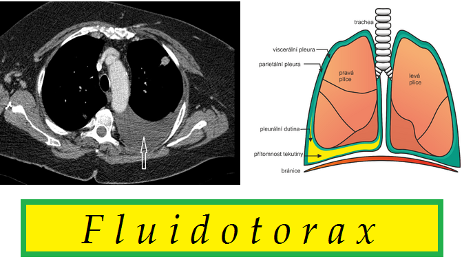 fluidotorax priznaky projevy symptomy