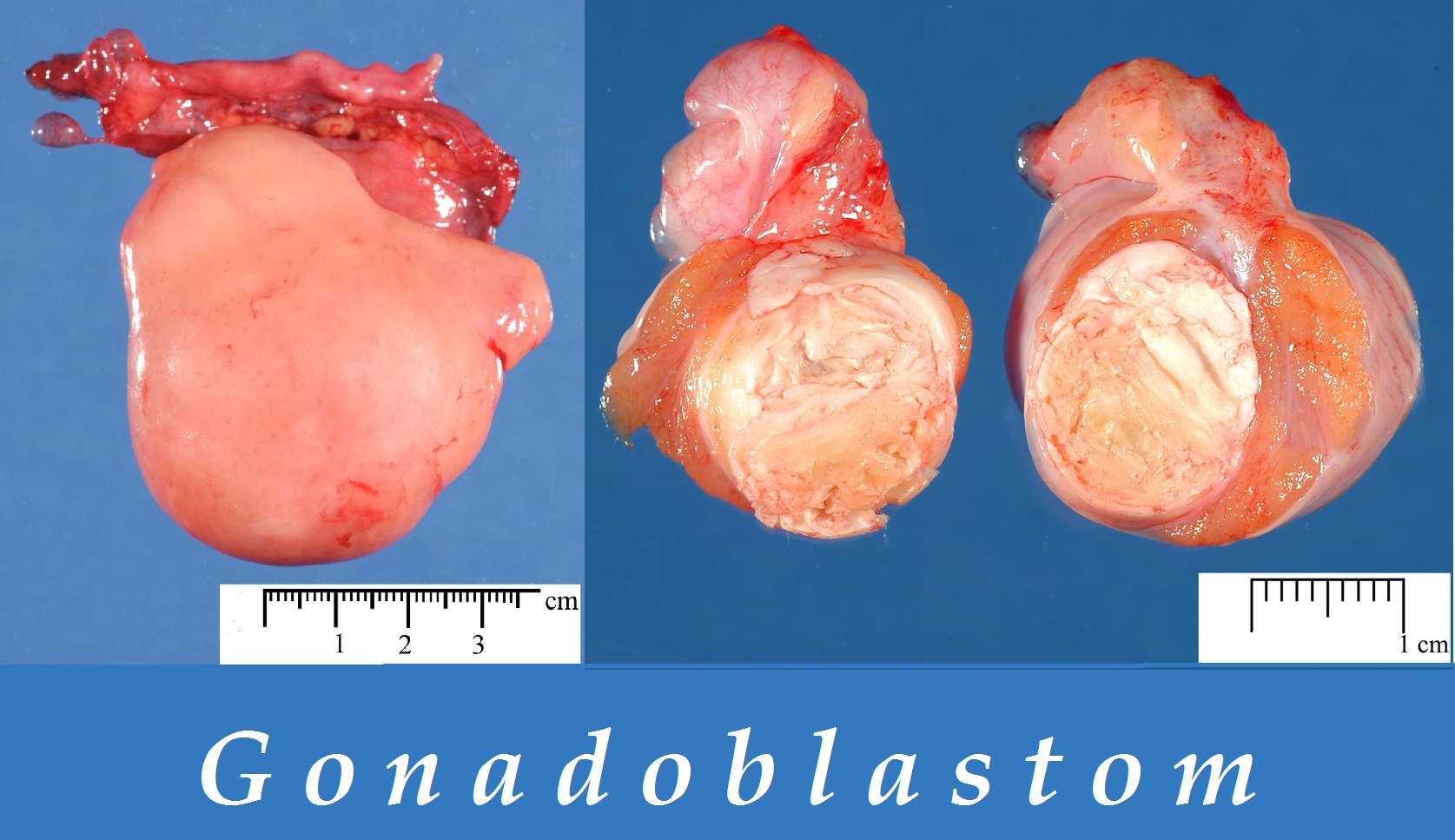 gonadoblastom-priznaky-projevy-symptomy