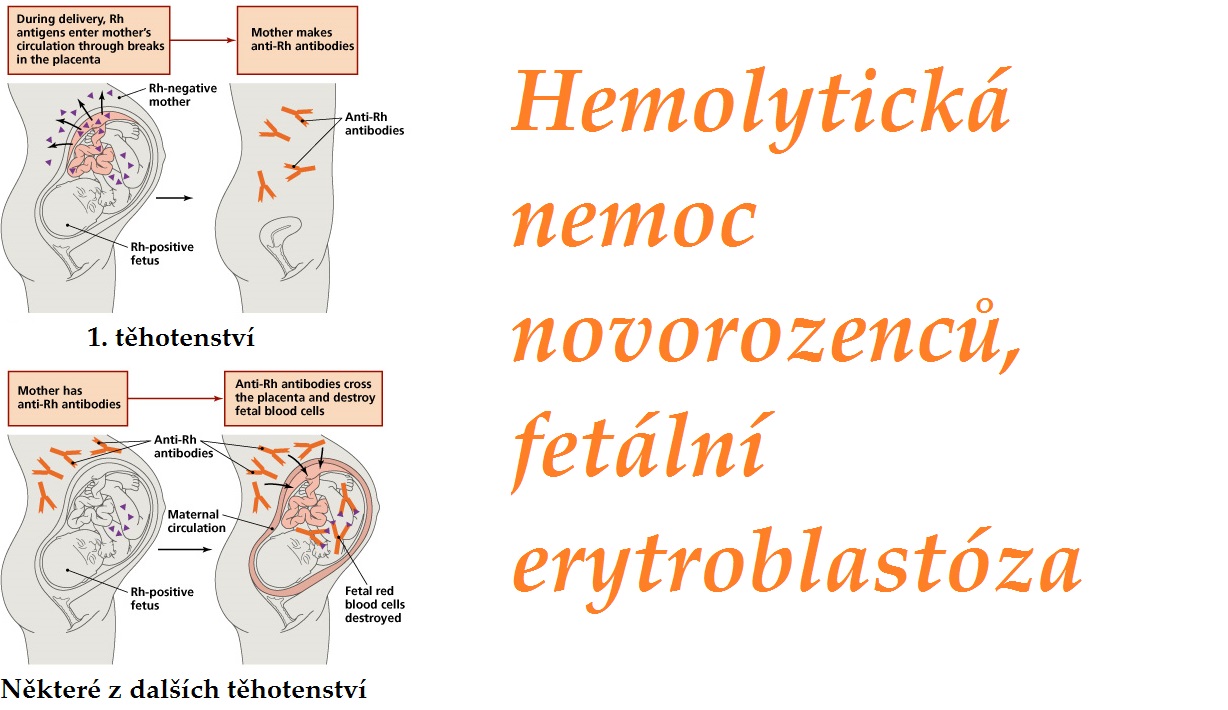hemolyticka nemoc novorozencu fetalni erytroblastoza priznaky projevy symptomy pricina lecba