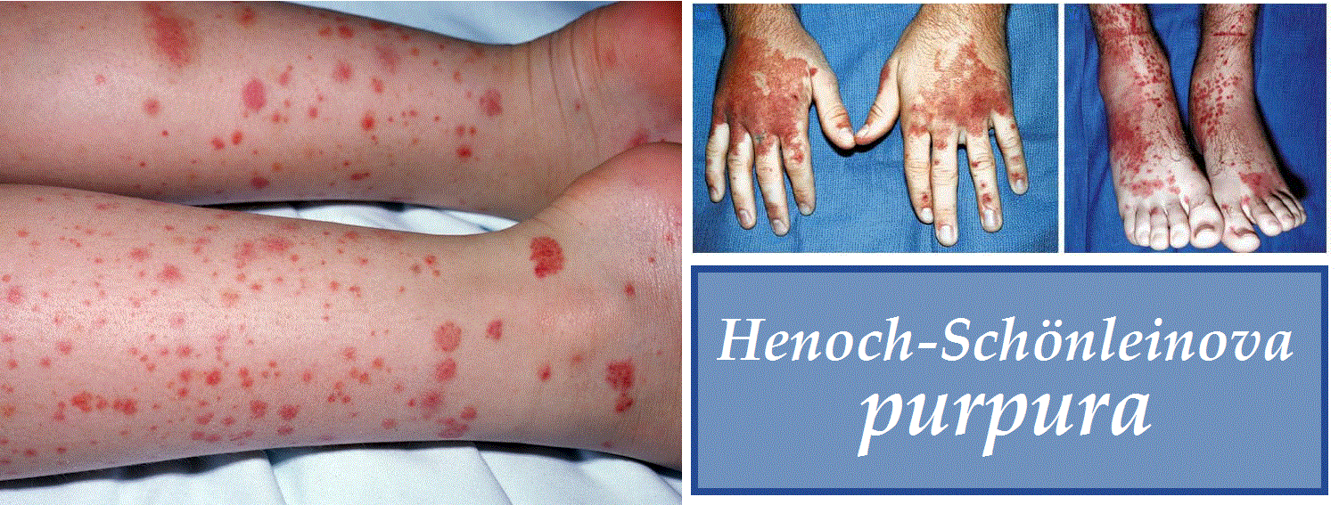 henoch-schonleinova-purpura-priznaky-projevy-symptomy