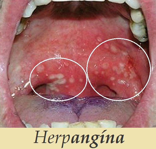 herpangina priznaky projevy symptomy pricina lecba fotografie obrazek fotografie obrazek