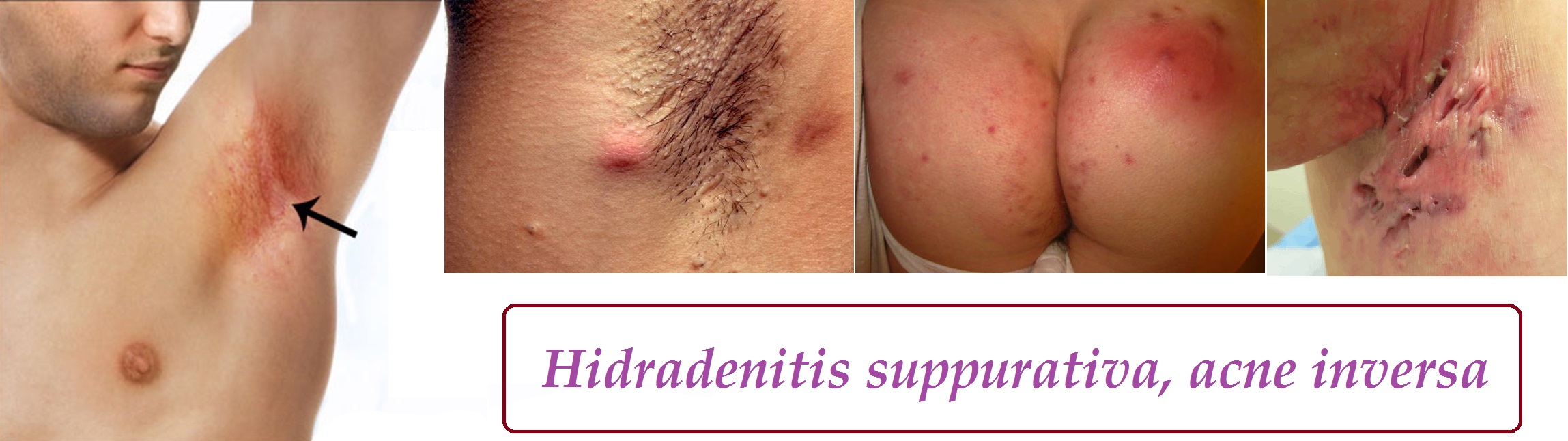 hidradenitis suppurativa acne inversa priznaky projevy symptomy pricina lecba fotografie obrazek