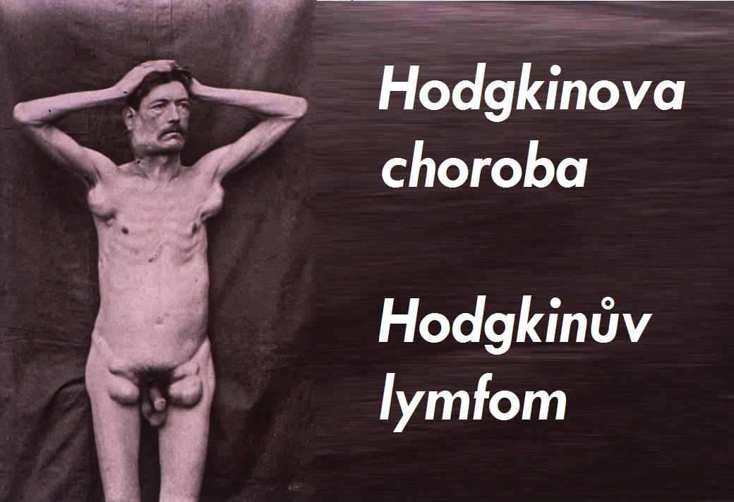 hodgkinuv-lymfom-hodgkinsky-lymfom-priznaky-projevy-symptomy-5