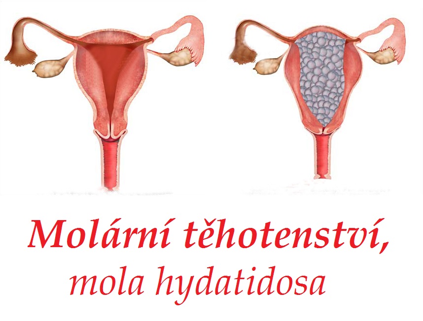 hydatidozni mola molarni tehotenstvi priznaky projevy symptomy