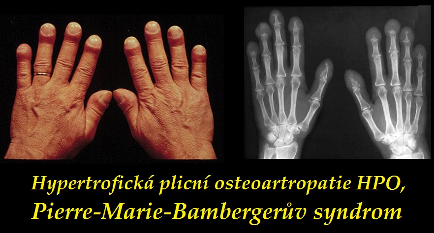 hypertroficka plicni osteoartropatie hpo pierre marie bambergeruv syndrom sekundarni hypertroficka plicni osteoartropatie priznaky projevy symptomy