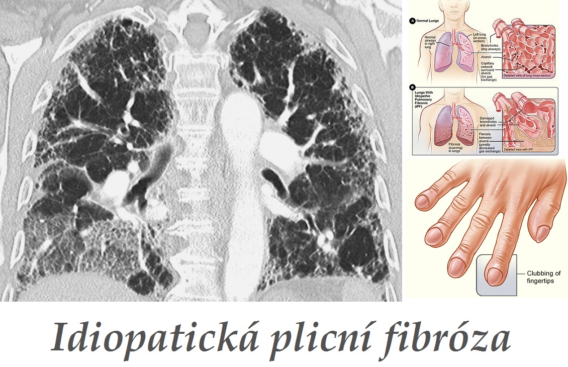 idiopaticka plicni fibroza priznaky projevy symptomy pricina lecba