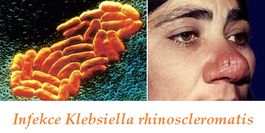 infekce klebsiella rhinoscleromatis priznaky projevy symptomy