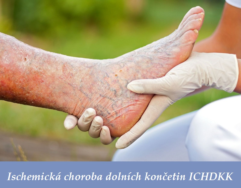 ischemicka-choroba-dolnich-koncetin-ichdkk-priznaky-projevy-symptomy