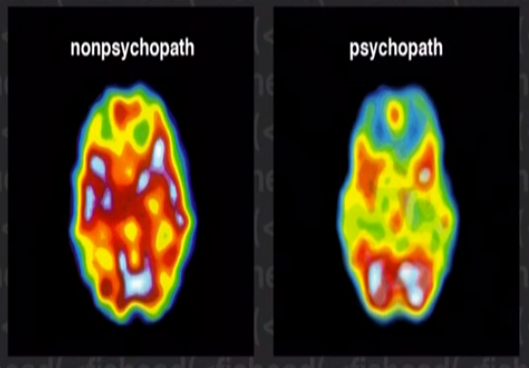 psychopat mozek magnetická rezonance