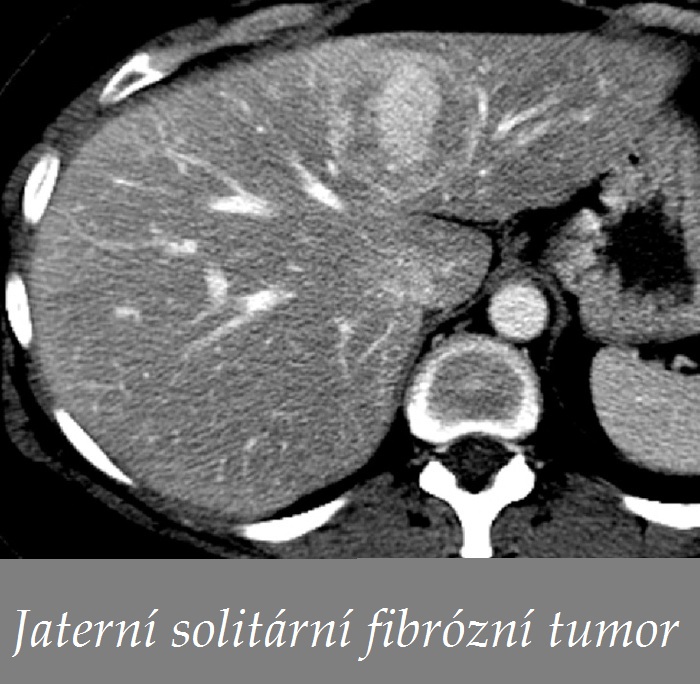 jaterni-solitarni-fibrozni-tumor-priznaky-projevy-symptomy