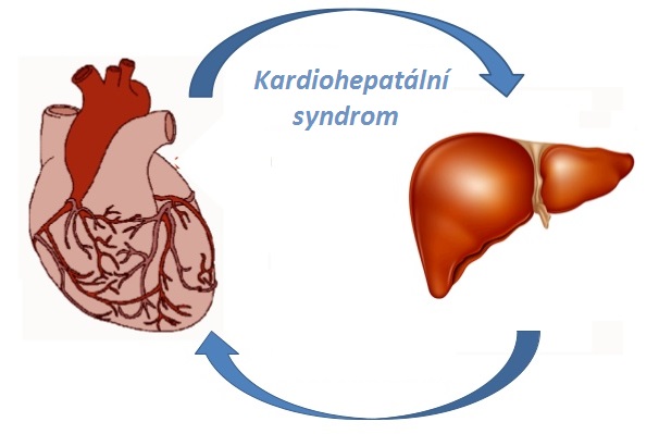 Kardiohepatální syndrom příznaky projevy symptomy příčina léčba
