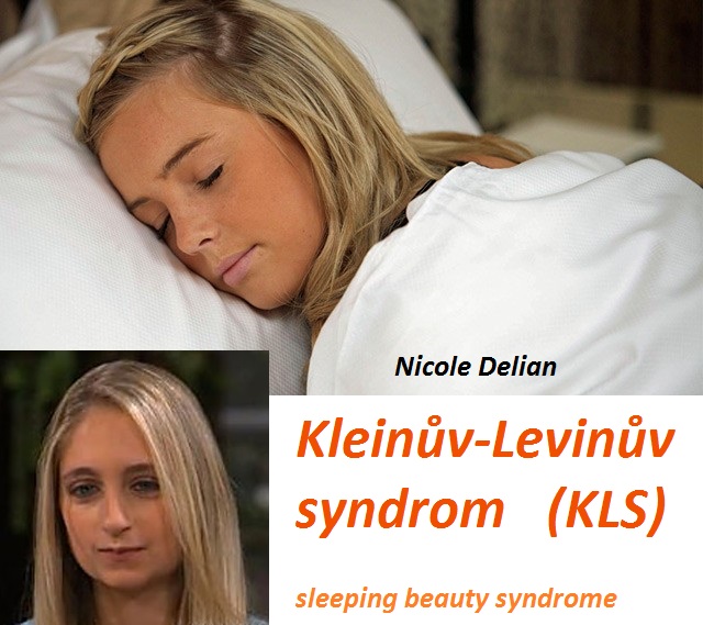 kleinuv-levinuv-syndrom-priznaky-projevy-symptomy