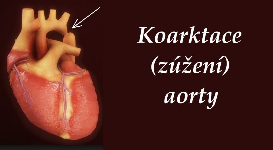 koarktace-aorty-priznaky-projevy-symptomy