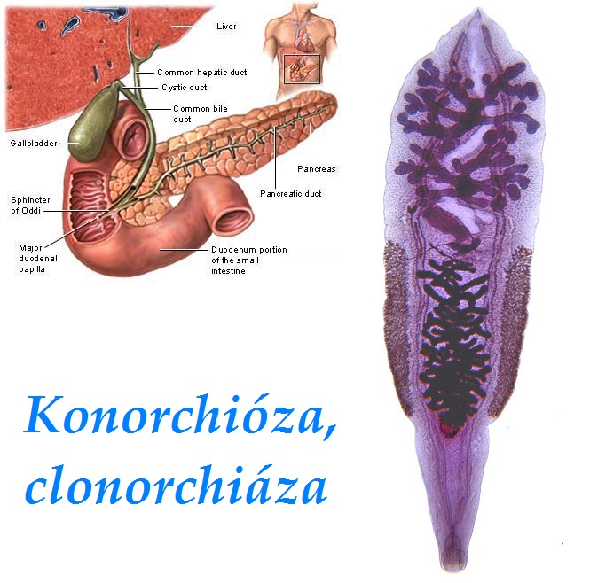 konorchioza clonorchiaza motolice zlucova priznaky projevy symptomy