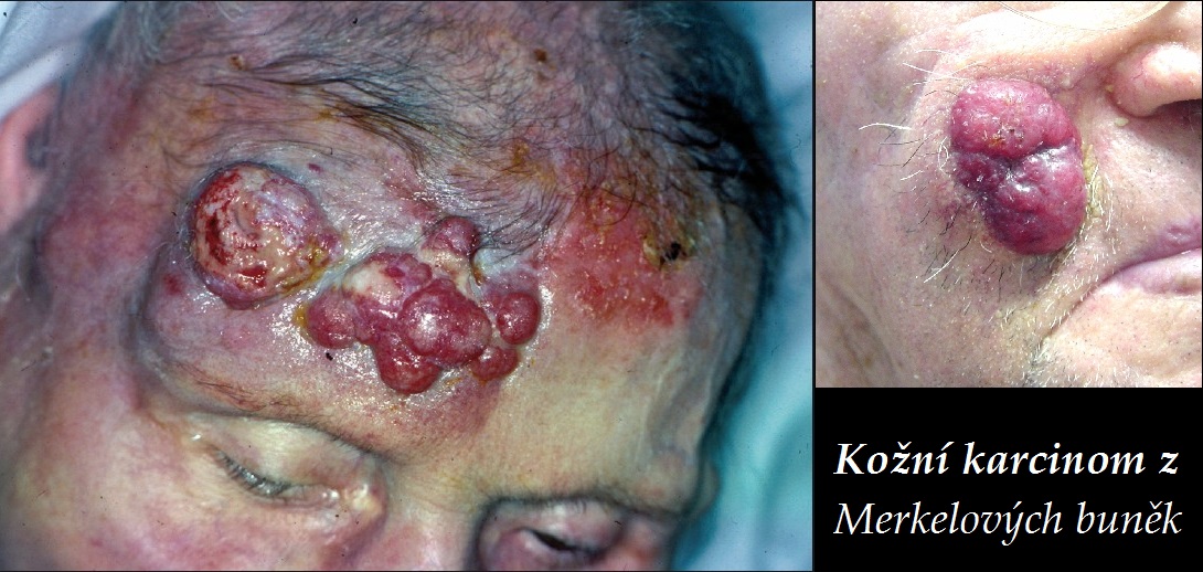 kozni karcinom z merkelovych bunek merkel cell skin carcinoma priznaky projevy symptomy