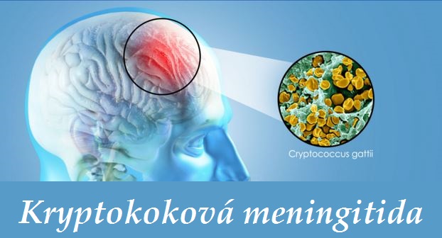 kryptokokova meningitida priznaky projevy symptomy