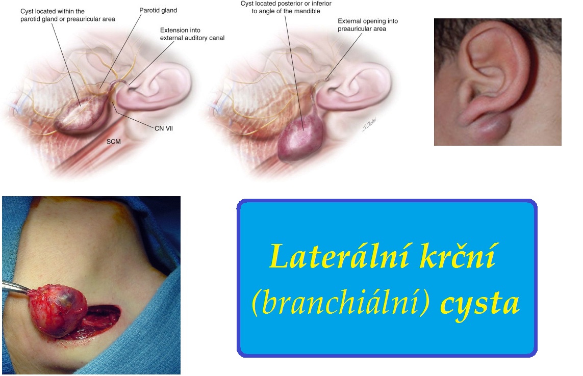 lateralni krcni branchialni cysta priznaky projevy symptomy
