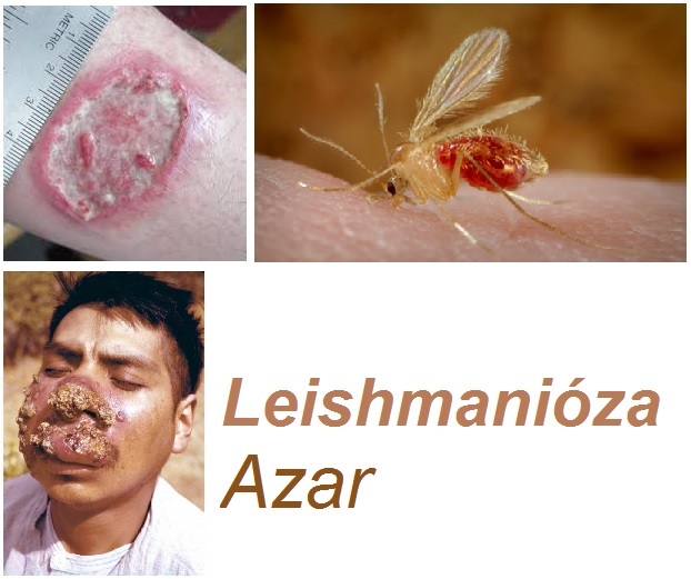 leishmanioza-azar-priznaky-projevy-symptomy-obrazek-fotografie