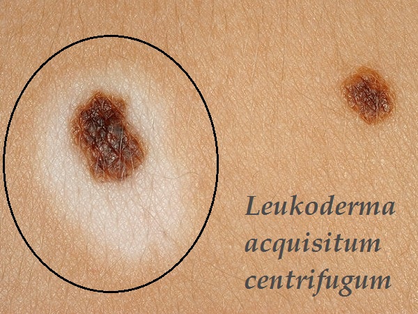 leukoderma-acquisitum-centrifugum-priznaky-projevy-symptomy-foto-fotografie-obrazek