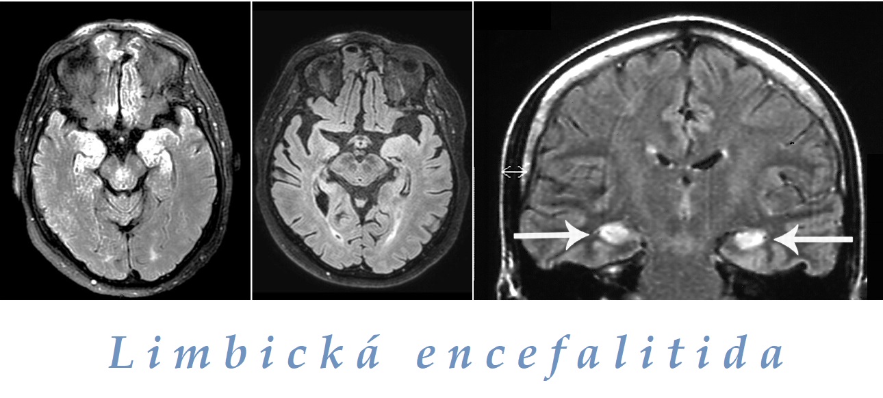Limbická encefalitida příznaky projevy CT MR NMR snímek obrázek příčina léčba