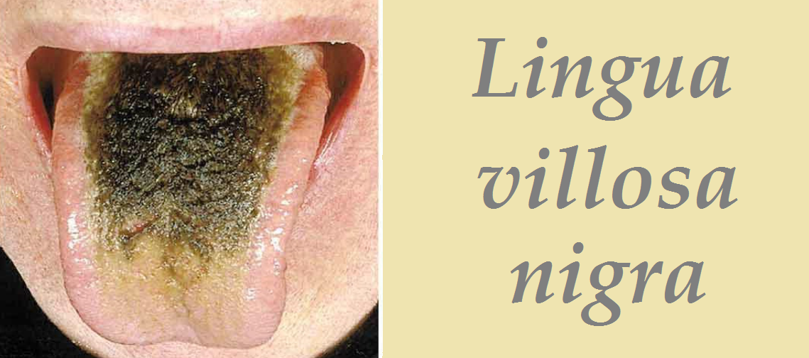 lingua-villosa-nigra-priznaky-projevy-symptomy