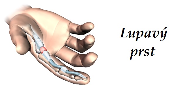 lupavy prst priznaky projevy symptomy
