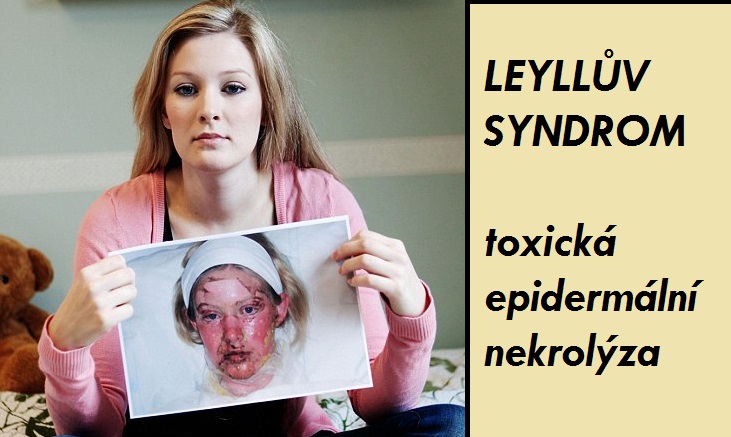 lyelluv-syndrom-toxicka-epidermalni-nekrolyza-priznaky-projevy-symptomy-16