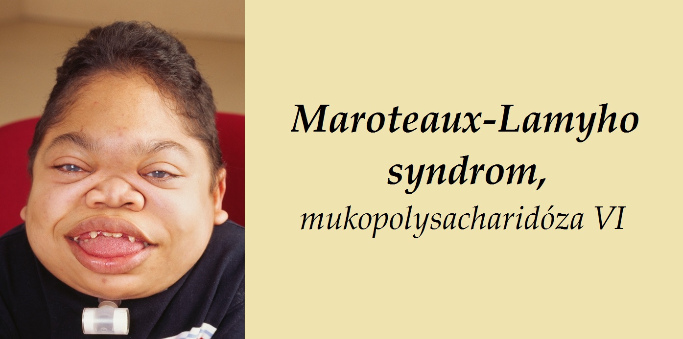maroteaux lamyho syndrom mukopolysacharidoza typ vi priznaky projevy symptomy pricina lecba 2