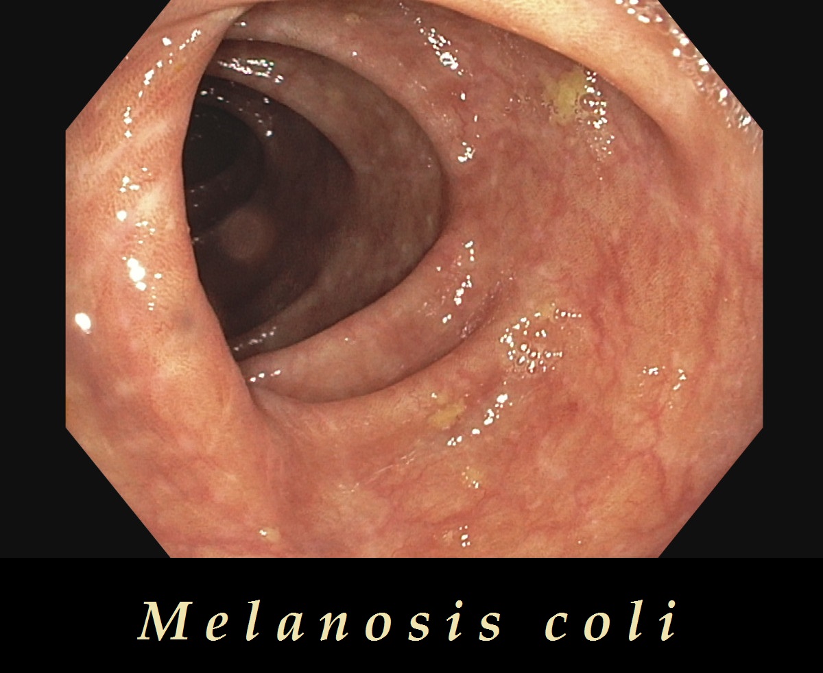 melanosis-coli-priznaky-projevy-symptomy